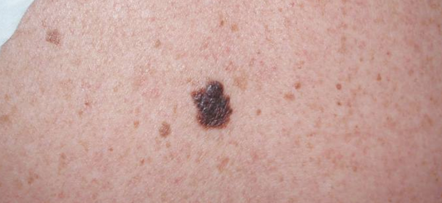 Melanoma