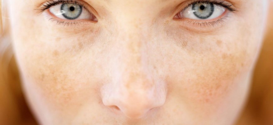 melasma