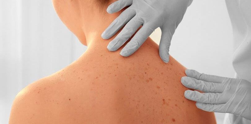 Inteligencia Artificial identifica sinais de câncer melhor que Dermatologistas