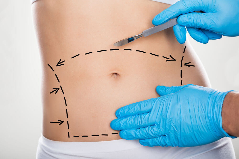 quanto custa uma abdominoplastia