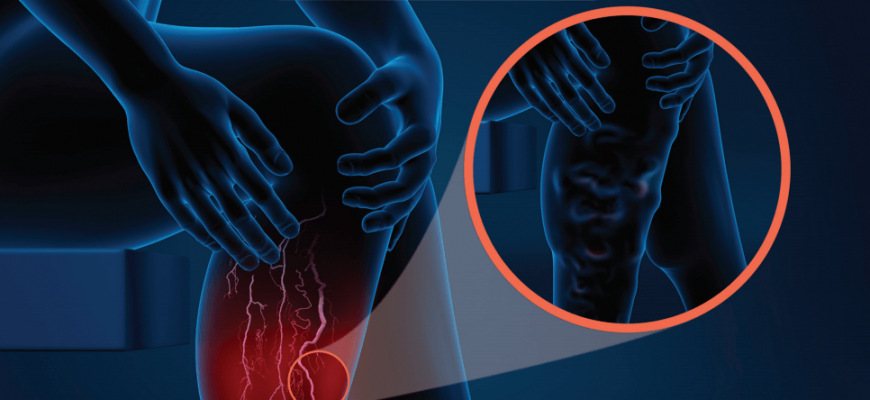 cirurgia de varizes