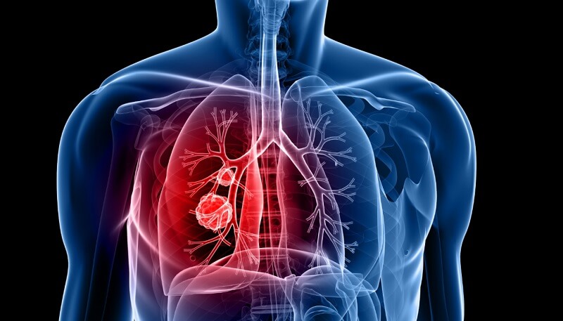 quais são os sintomas da pneumonia