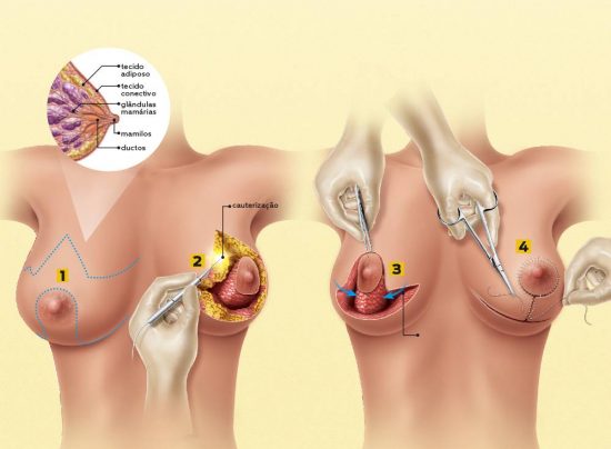 Cirurgia de Redução de Mama