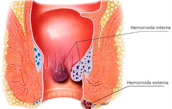 sintomas de hemorroida