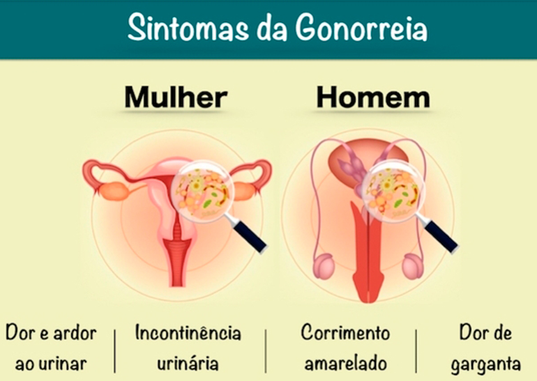 gonorreia
