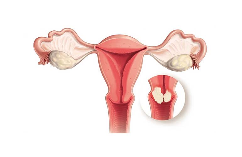 sintomas de câncer cervical corpo 2