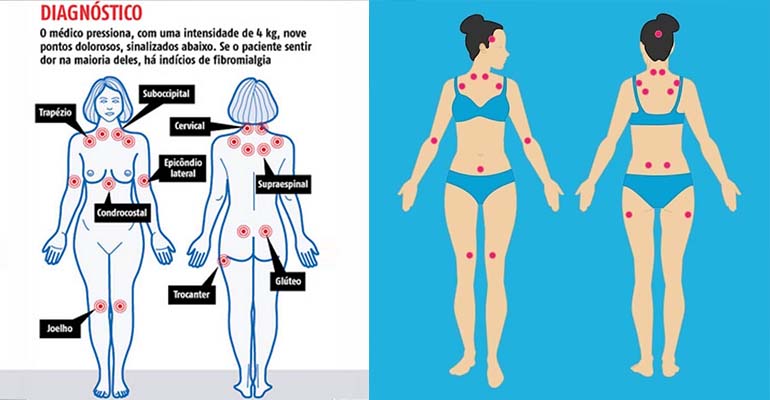 FIBROMIALGIA TEM CURA CAPA