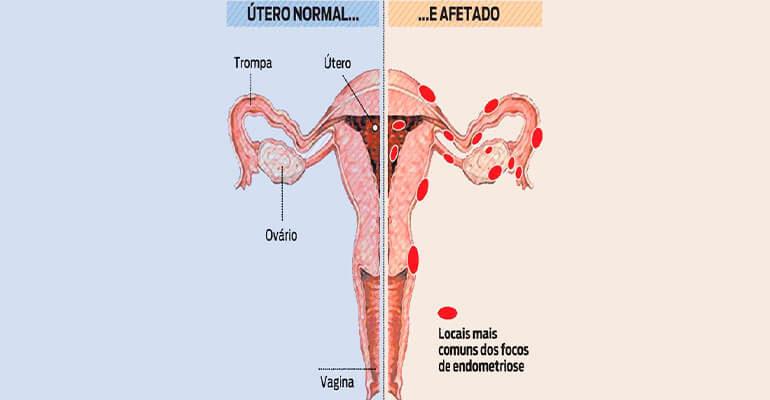 Endometriose