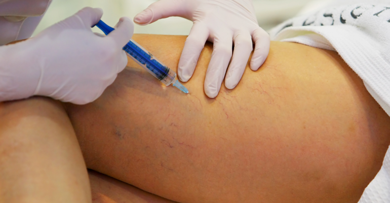 Mulher aplicando produto nas varizes da perna de outra mulher.