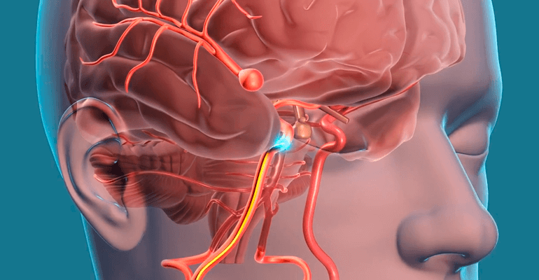 Representação 3D de um aneurisma cerebral