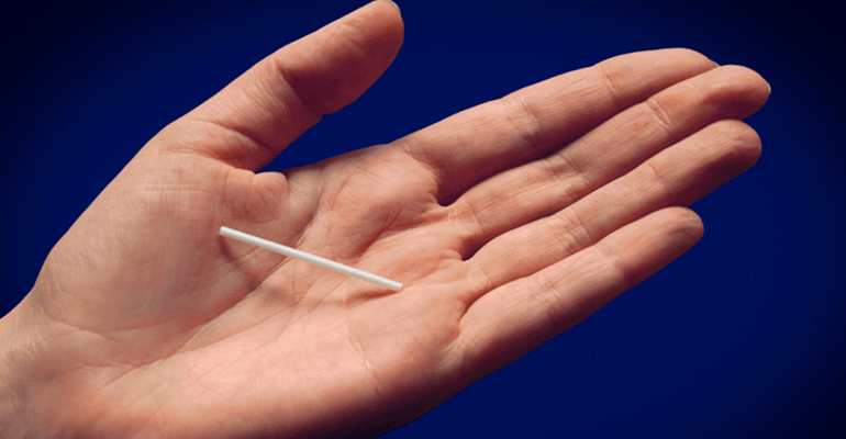 Mulher segurando implante anticoncepcional
